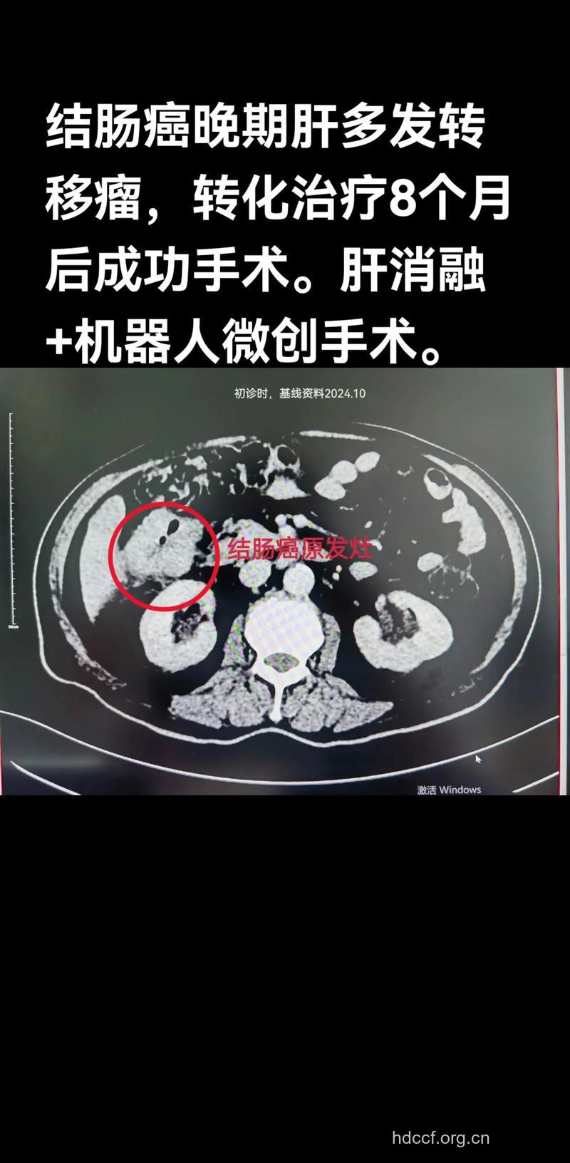 结直肠癌肝转移宜手术治疗
