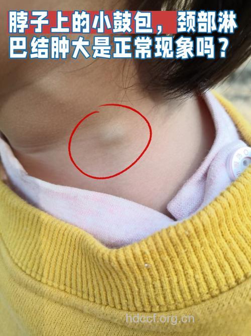颈部淋巴结核|颈部淋巴结核的症状