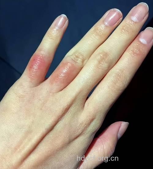 冻疮|冻疮的症状