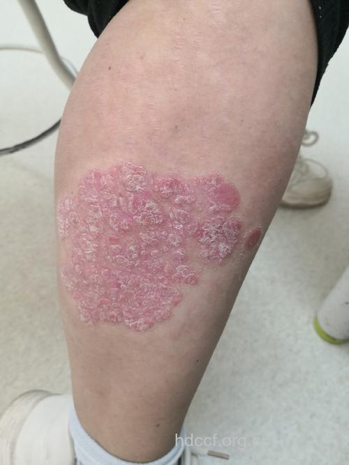 牛皮癣|牛皮癣的症状