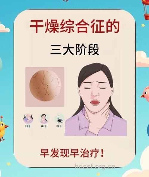 干燥综合征|干燥综合征的症状