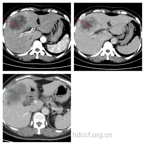 肝癌检查 MRI好还是CT好