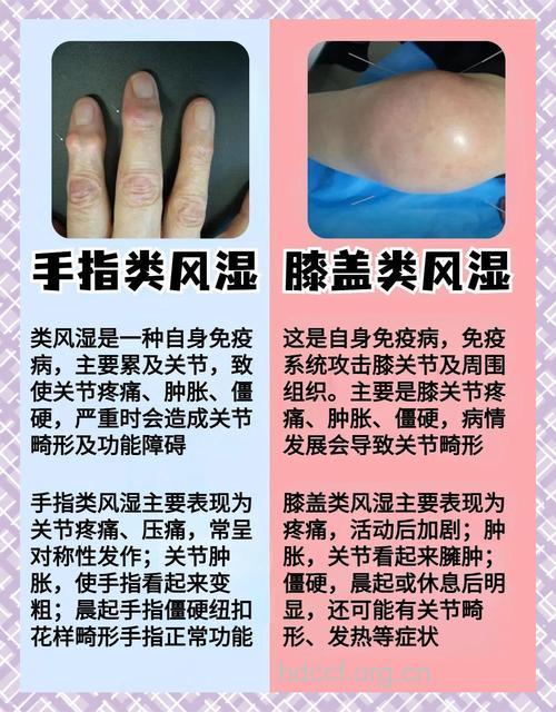 类风湿性关节炎|类风湿性关节炎的症状
