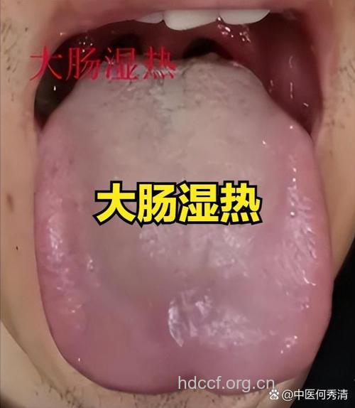 什么是小肠实热证？