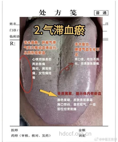 什么是瘀阻脑络证？