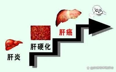 肝友,你离肝癌有多远?