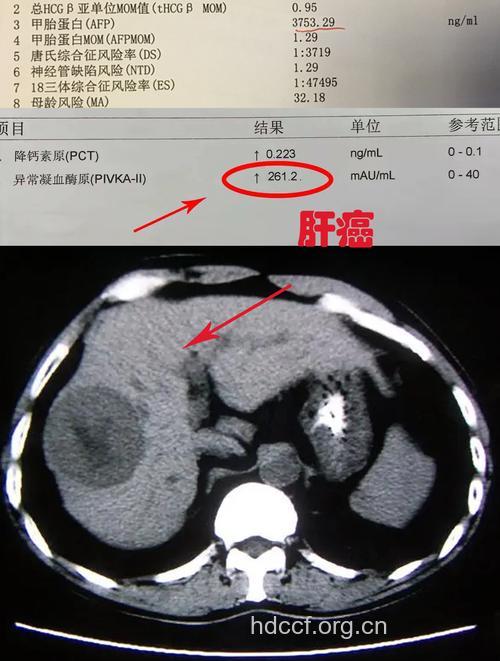 电子计算机断层扫描检查肝癌