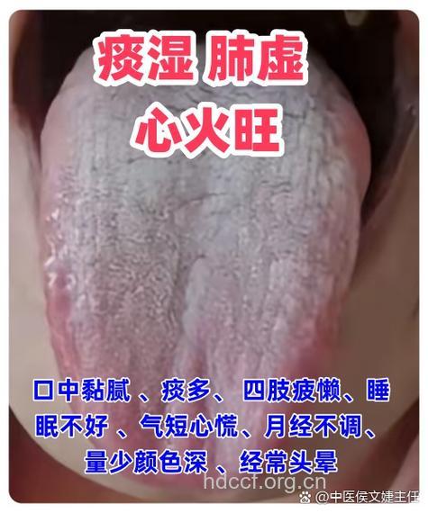 什么是肺热炽盛证？