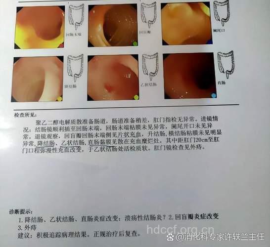什么是虫积肠道证？