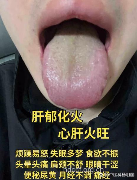 什么是肝胆湿热证？