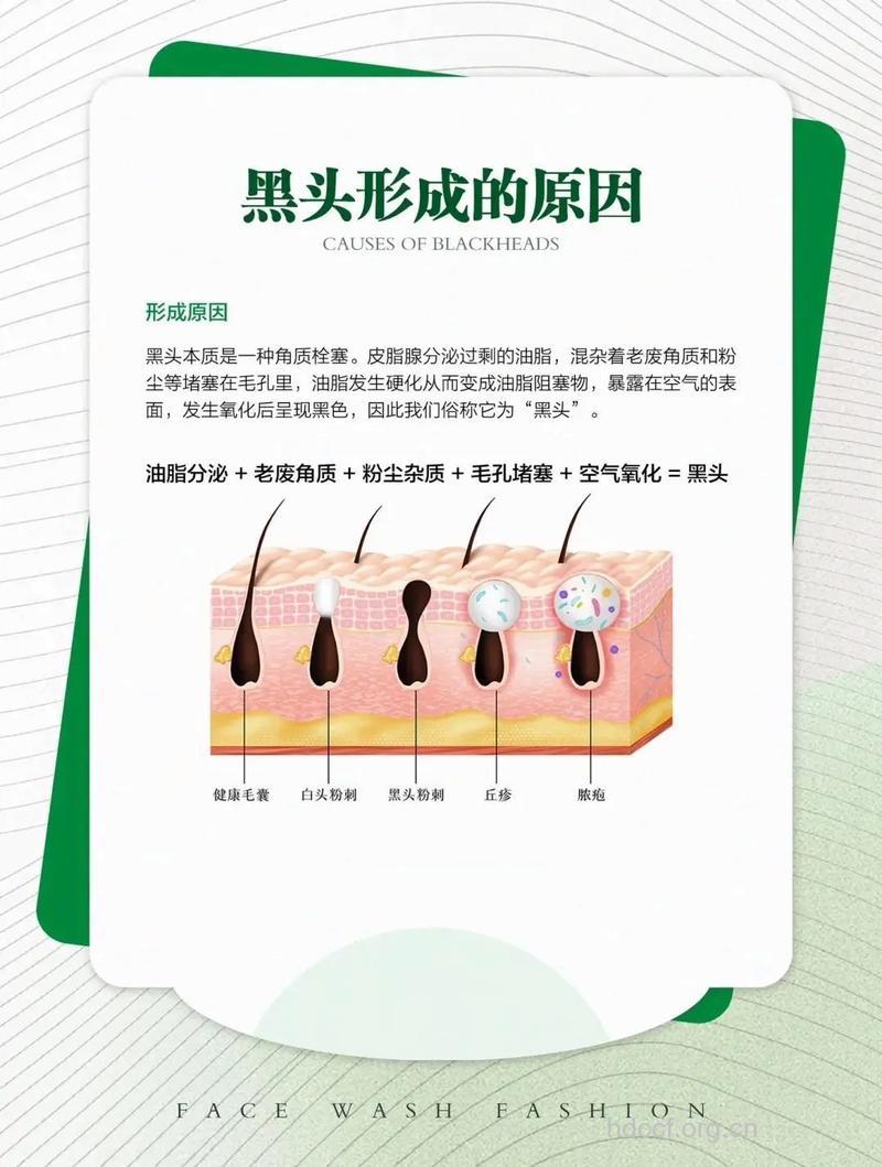 黑头影响美观 这些原因让黑头疯长