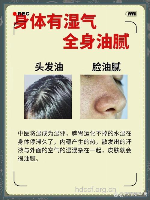 头发出油严重 与湿气也有关系