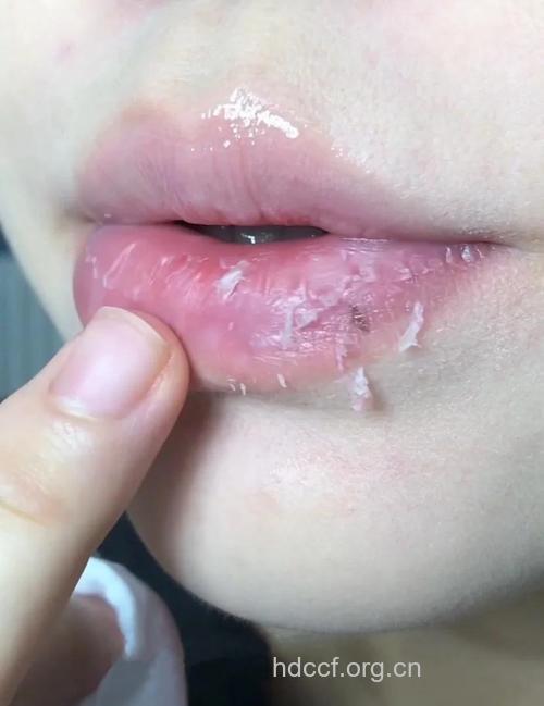 春季嘴唇依旧干燥 要多补水