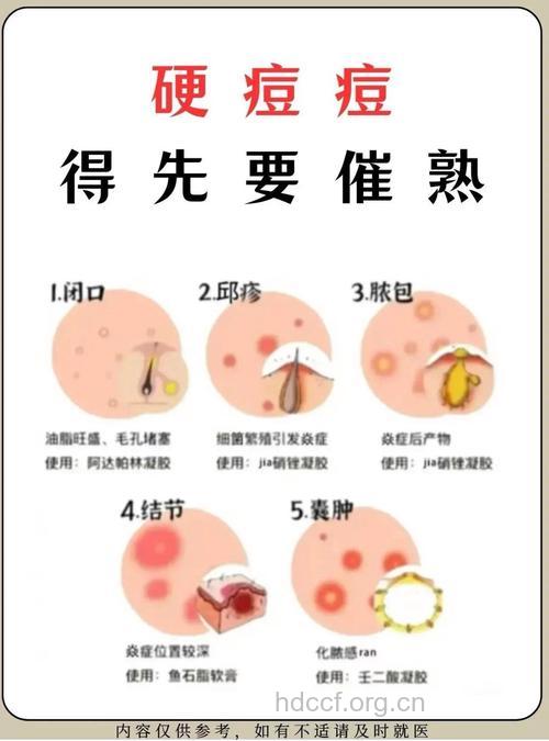 手挤痘痘有危险 中医教你祛痘方法