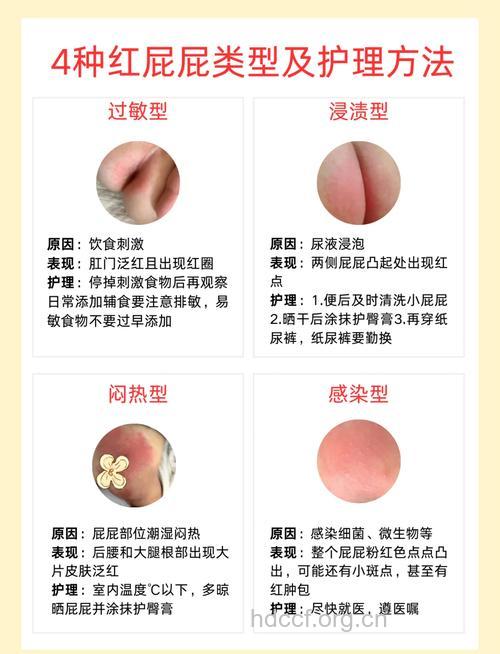 新生儿红臀怎么办?