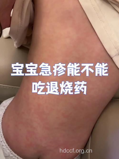 疹子未出齐,勿用退烧药