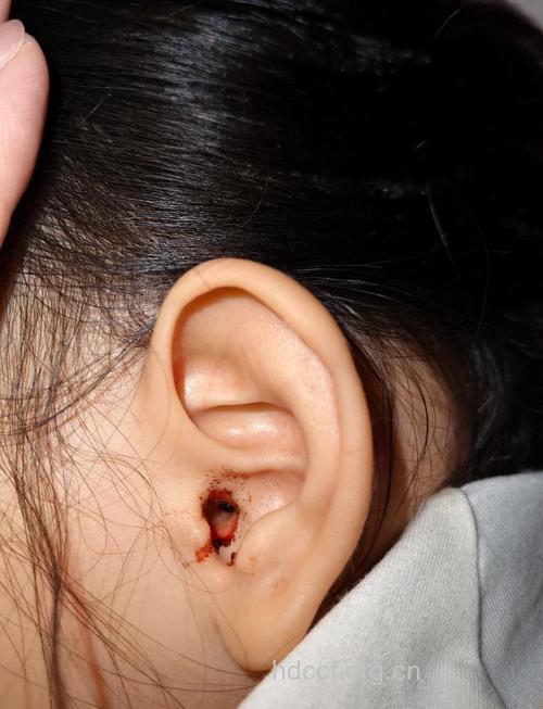 头部外伤耳鼻流血水