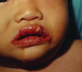 维生素A的中毒症状