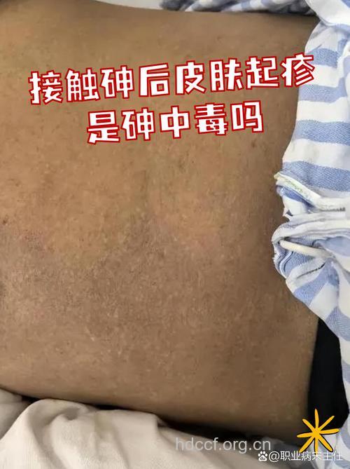 皮肤真的会中毒吗？