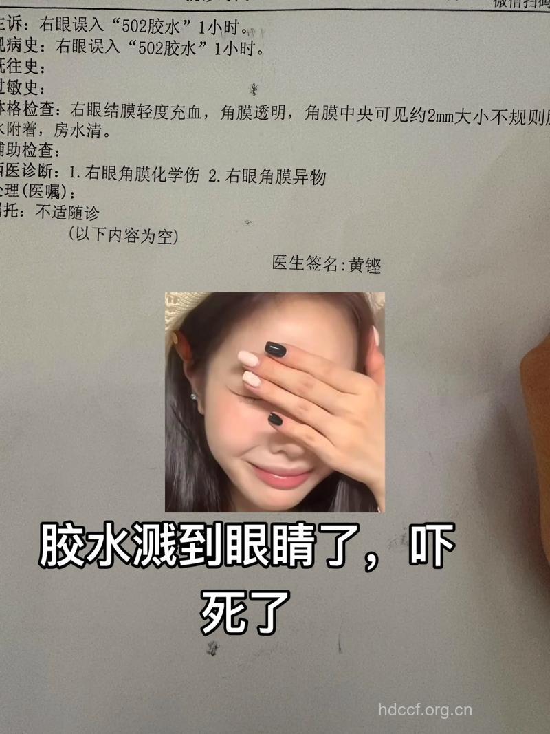 502胶水进眼睛了要怎么办