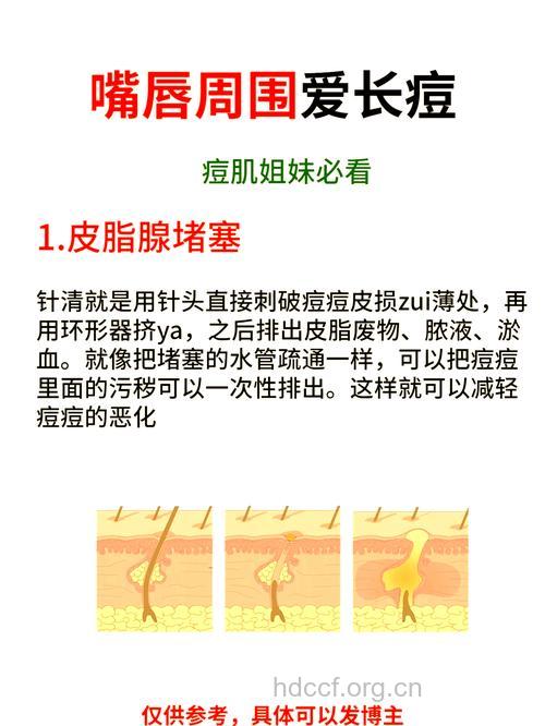 嘴上长痘是胃火大吗 如何去掉这些痘痘