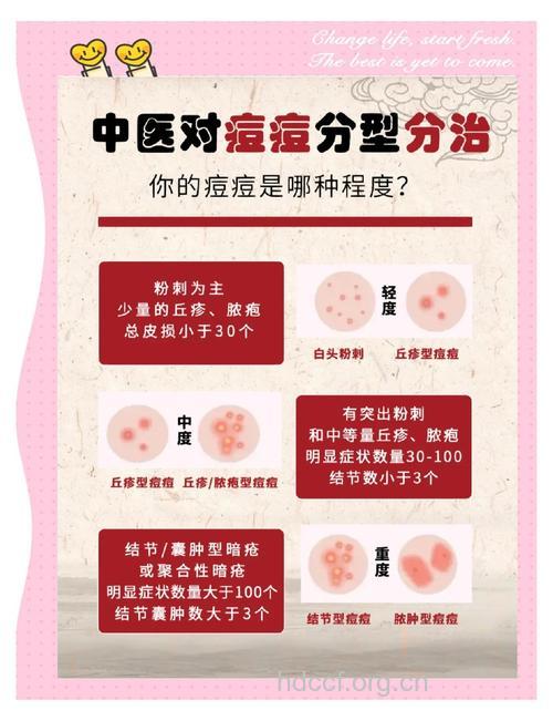 青春痘来袭 中医治疗痘痘先分类