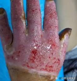 强酸、强碱中毒症状