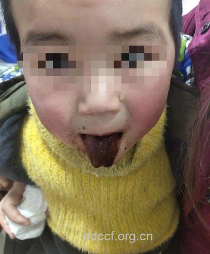 小儿误服高锰酸钾中毒后症状