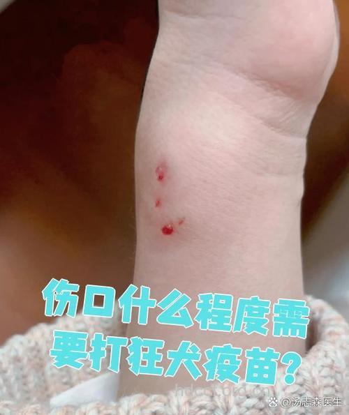 破损皮肤被宠物添 亦需注射狂犬疫苗