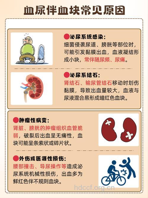 中老年人血尿 需警惕泌尿系肿瘤