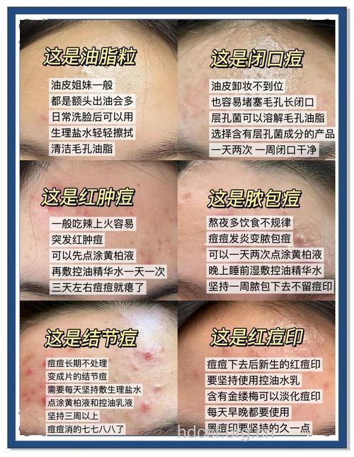 夏天额头长痘 试试这些方法去痘