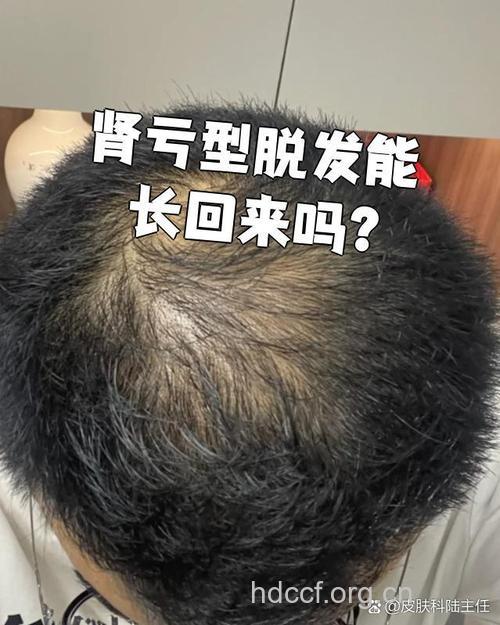 勿轻视脱发 男性脱发肾虚偏多