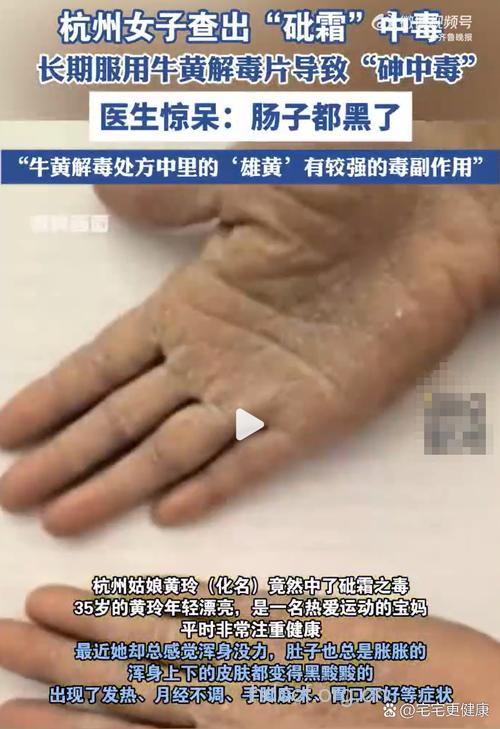 长期过量服用牛黄解毒片易中毒