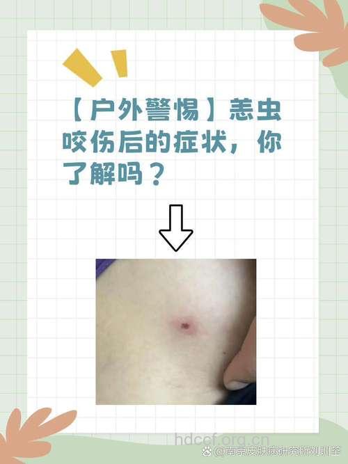 2人被恙虫咬伤致死 被恙虫咬伤怎么办