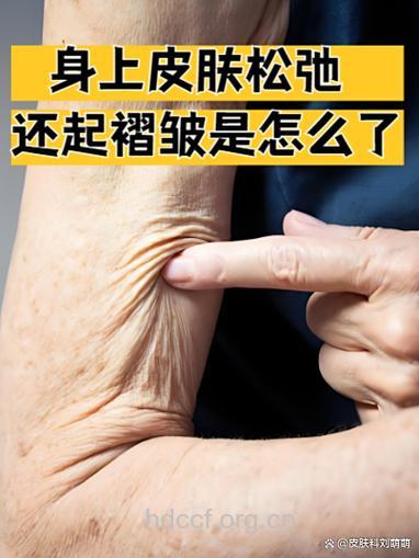 夏季出现橘皮纹怎么办