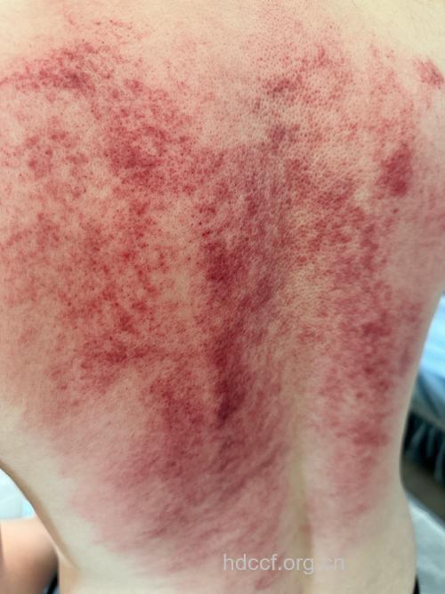 中医刮痧缩毛孔 肌肤细腻不再糙