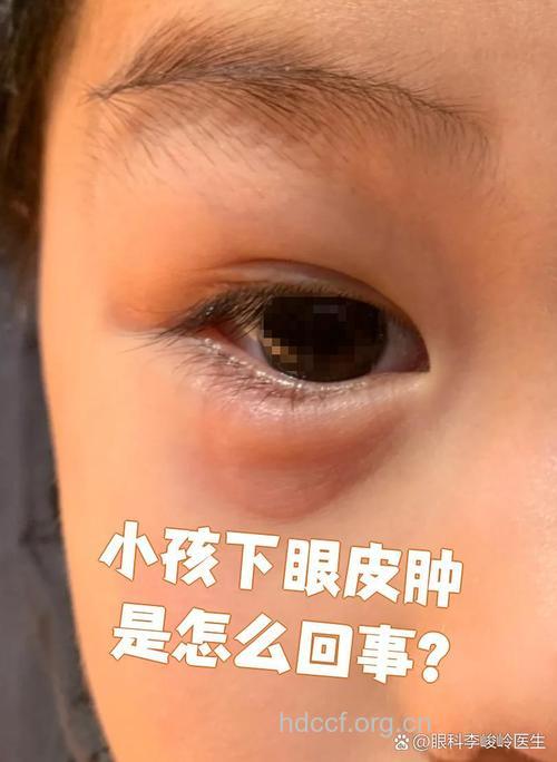 小儿眼皮肿 需警惕肾炎