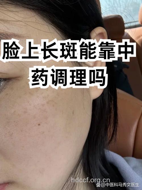 中医按摩祛肾虚雀斑
