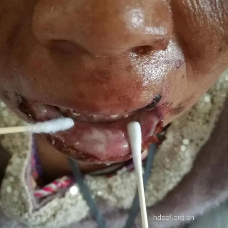 百草枯中毒的症状及治疗