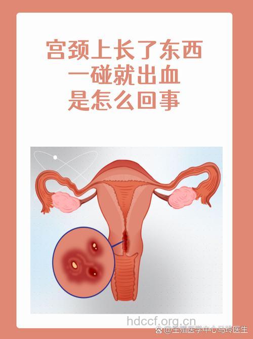 子宫颈接触性出血的妇科疾病有哪些?