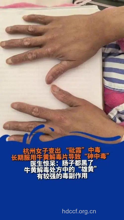 盐卤中毒症状表现