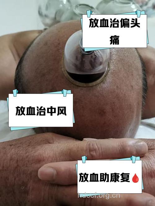 额头抹血治头晕不可取