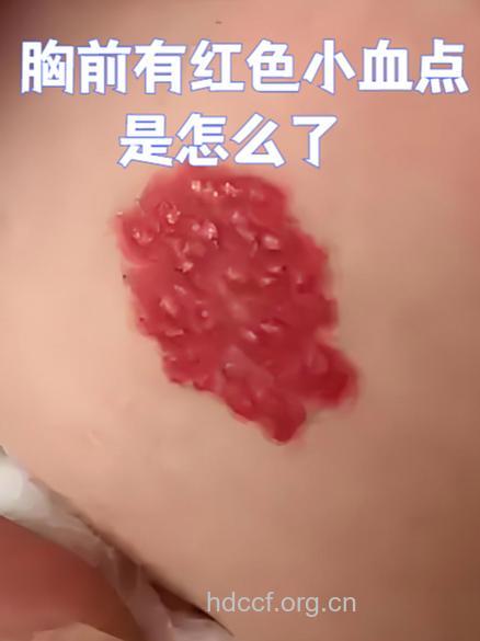 出现樱桃肤色是什么回事?