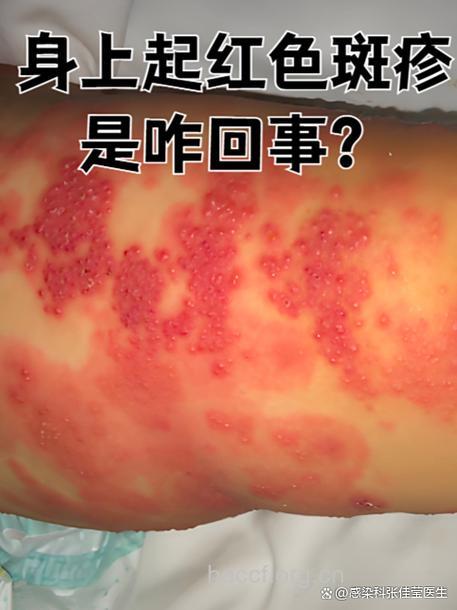 棉子中毒有临床症状