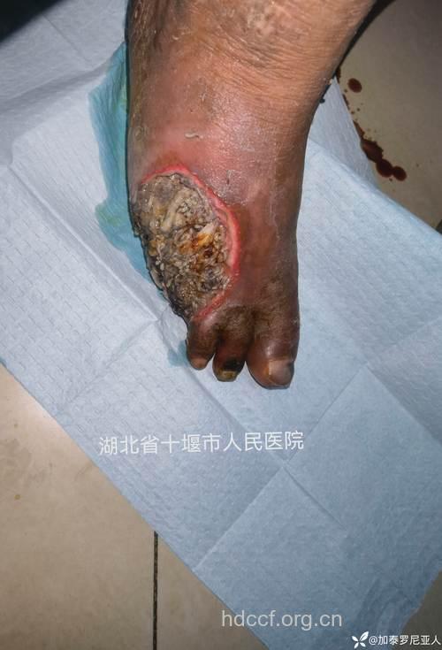 溴氯菊酯中毒的临床表现