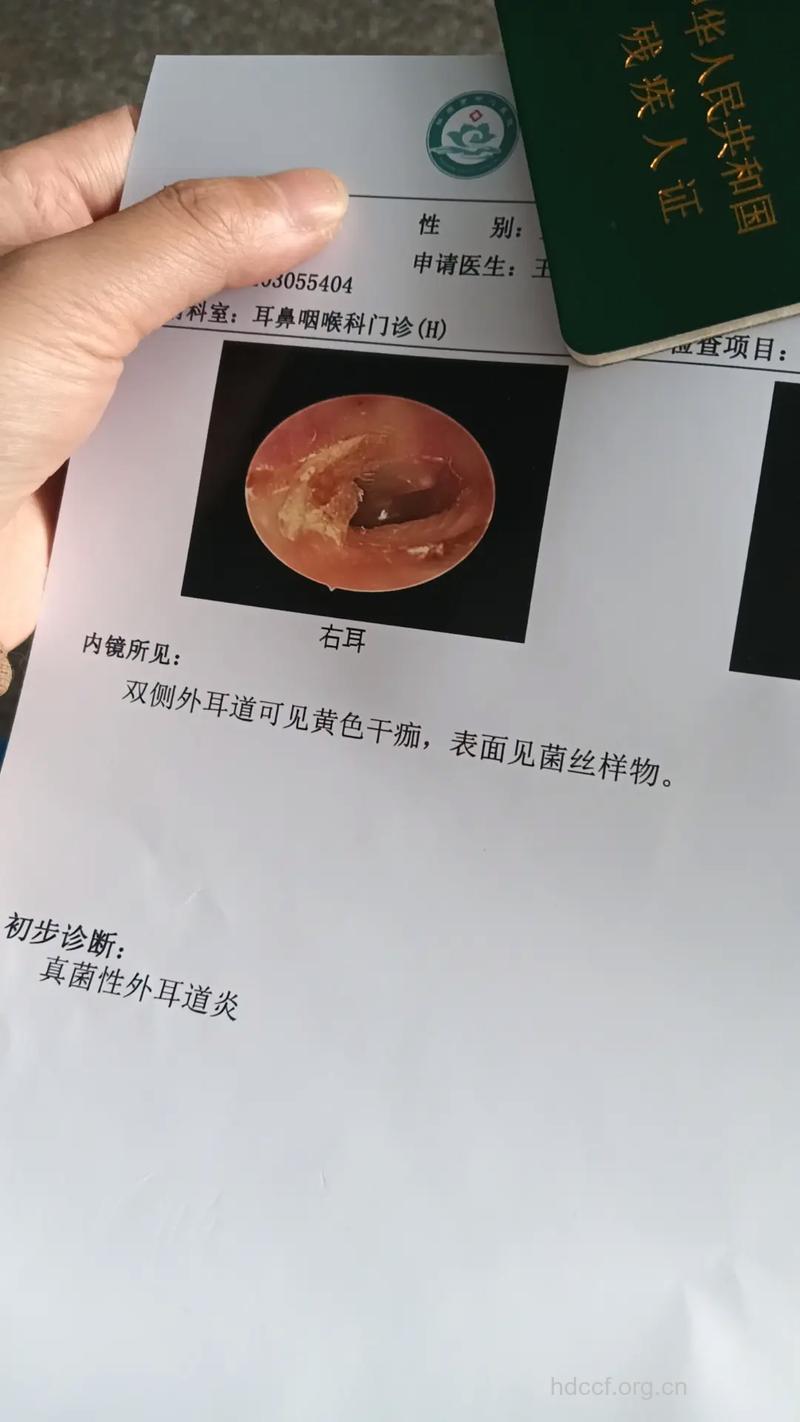 耳朵突然失聪应上耳科急诊