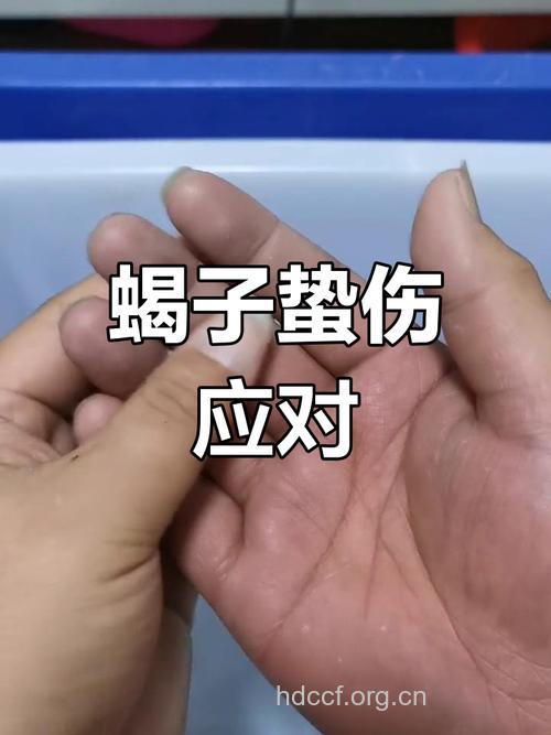 外出郊游被蝎子蛰伤的处理措施