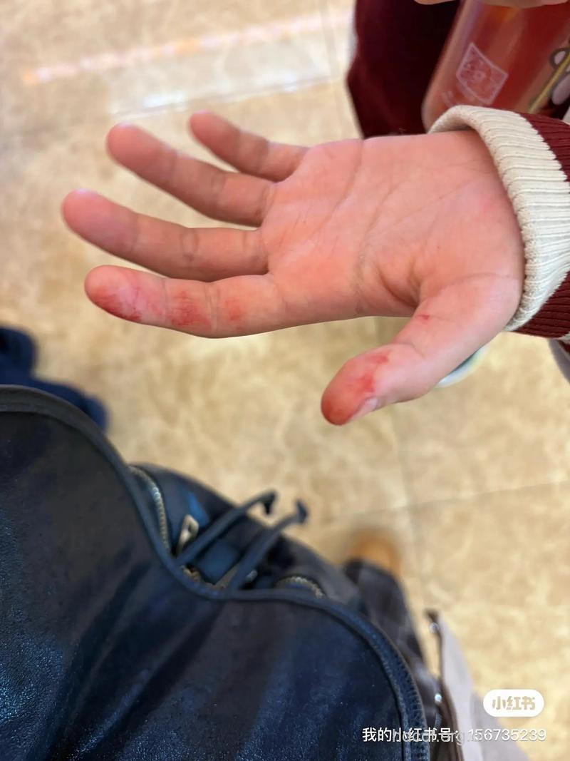 宝宝玩溜滑梯受伤了怎么办