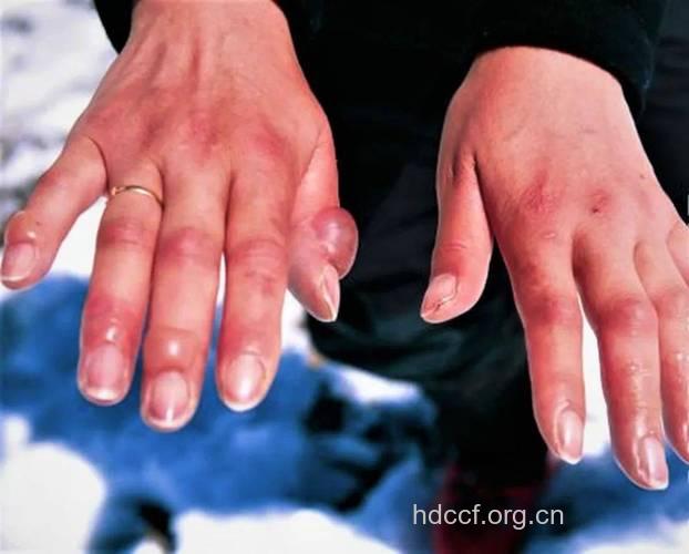 你知道冻伤早期症状是什么