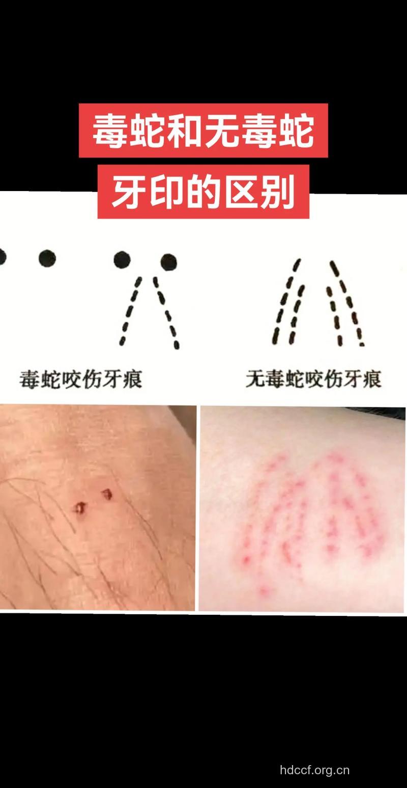 如何判断是哪一种毒蛇咬伤
